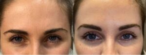 Cosmetic eyebrow/forehead lifts