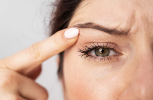 Cosmetic Upper eyelid blepharoplasty